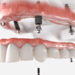 Jak jest różnica między protezą stałą a ruchomą?